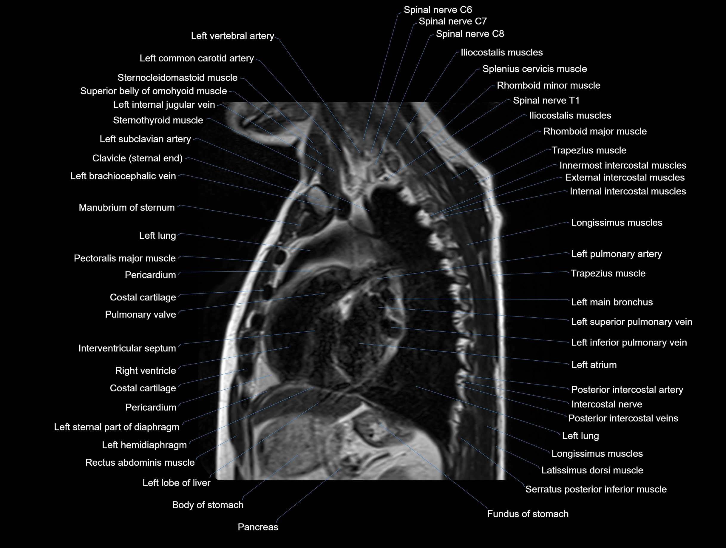 MRI chest (thorax) coronal  cross sectional anatomy 3T radiology  image-img-00001-00023.webp